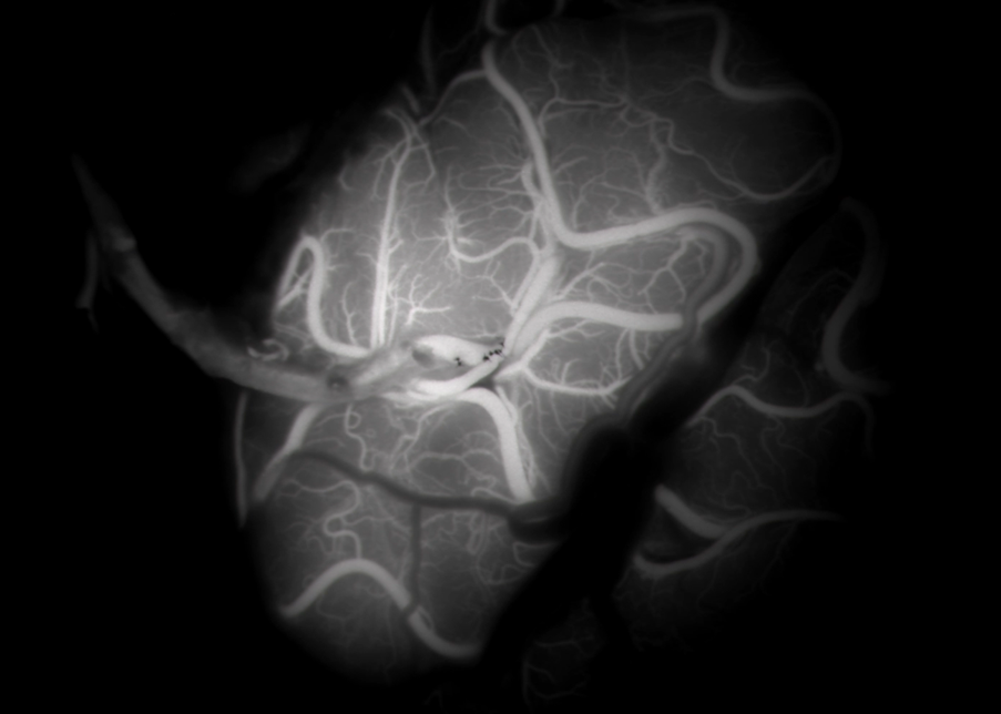 Figure 10. Intraoperative ICG angiography demonstrating absence of filling of aneurysm and delayed left MCA cortical filling.]